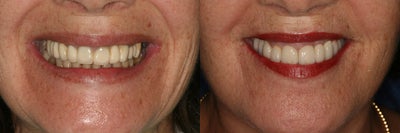 Smile Makeover before and after photo