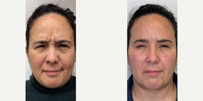 Botox before and after photo