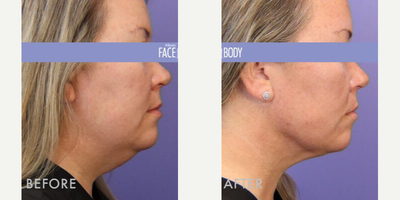 Chin Liposuction before and after photo