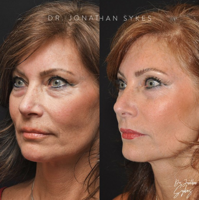Facelift before and after photo