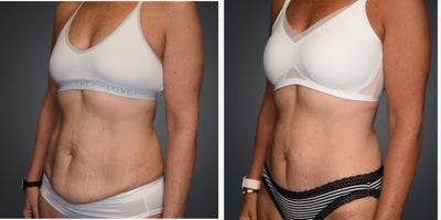 Liposuction before and after photo