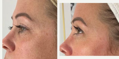 Microneedling before and after photo