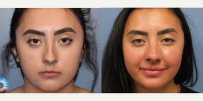 Rhinoplasty before and after photo