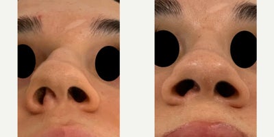 Septoplasty before and after photo