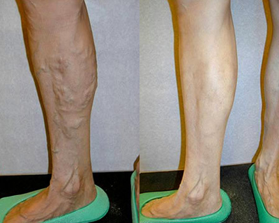EVLT before and after photo
