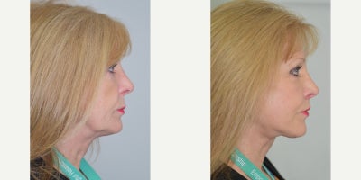 Lip Lift before and after photo