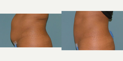 Liposuction before and after photo