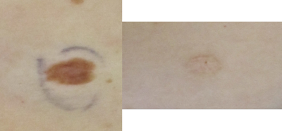Mole Removal before and after photo