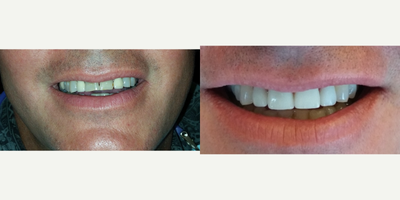 Porcelain Veneers before and after photo