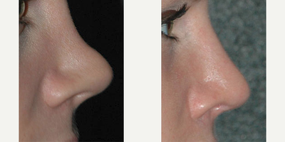 Revision Rhinoplasty before and after photo