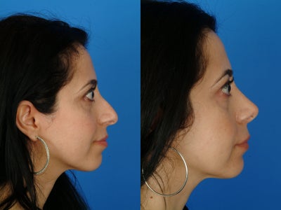 Rhinoplasty before and after photo