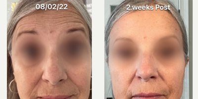 Botox before and after photo