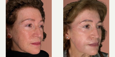 Chemical Peel before and after photo