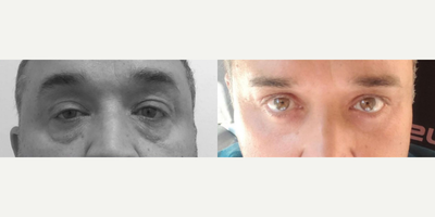 Eyelid Surgery before and after photo