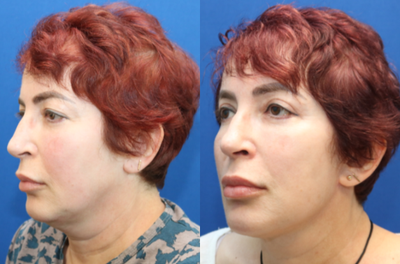 Facelift before and after photo