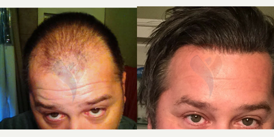NeoGraft before and after photo