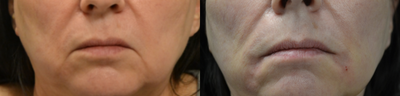 Restylane before and after photo
