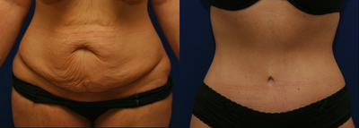 Tummy Tuck before and after photo