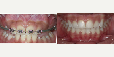 Braces before and after photo