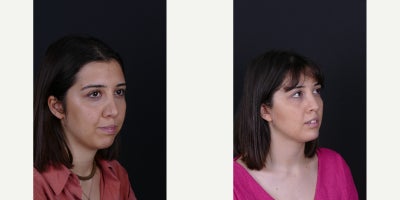 Buccal Fat Removal before and after photo