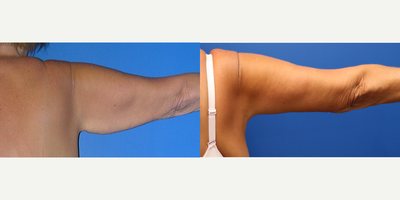 Arm Lift before and after photo