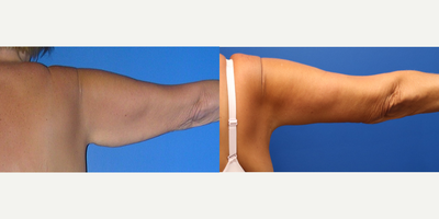 Arm Lift before and after photo
