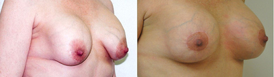 Breast Implant Removal before and after photo
