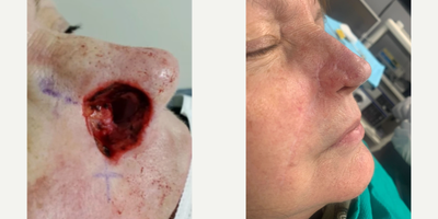 Mohs Surgery before and after photo