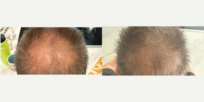 PRP Injections before and after photo