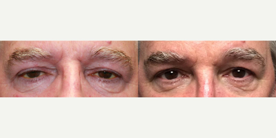 Ptosis Surgery before and after photo