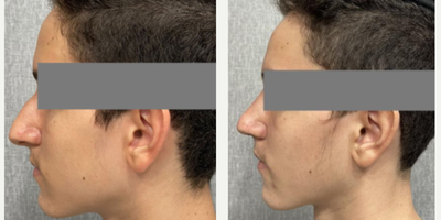 Rhinoplasty before and after photo
