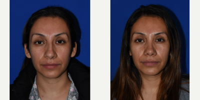 Rhinoplasty before and after photo