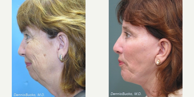 Facelift before and after photo