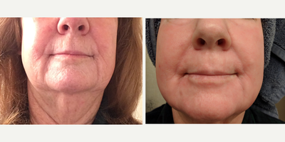 Fractional Laser before and after photo