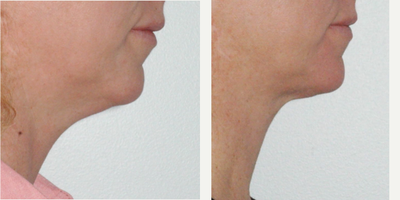 before and after image