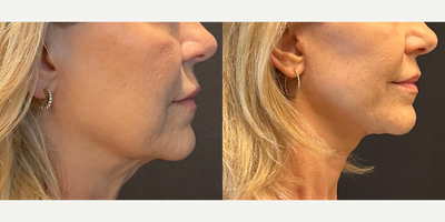 Neck Lift before and after photo