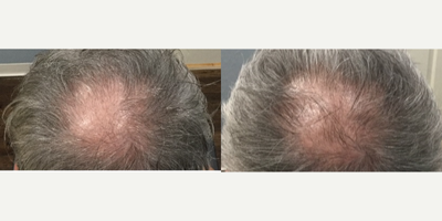 PRP for Hair Loss before and after photo