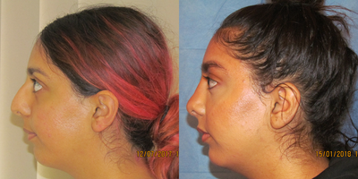 Rhinoplasty before and after photo