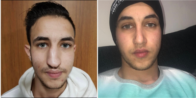 Rhinoplasty before and after photo