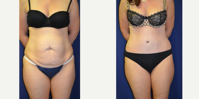 Tummy Tuck before and after photo