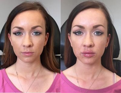 Juvederm before and after photo