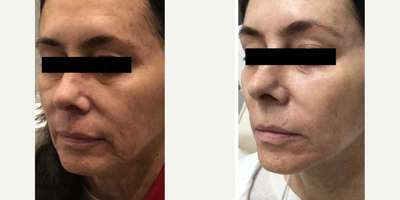 Sculptra before and after photo
