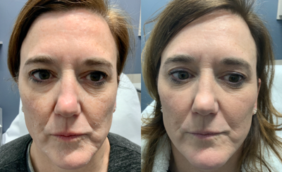Vollure before and after photo