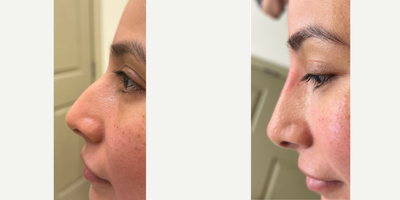 Dermal Fillers before and after photo