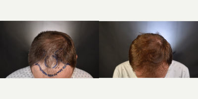 Hair Transplant before and after photo