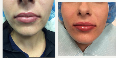 Juvederm before and after photo