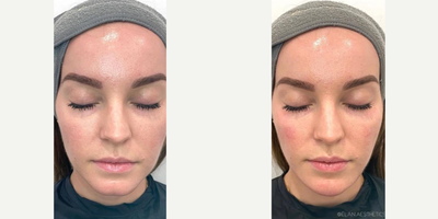 Dermal Fillers before and after photo