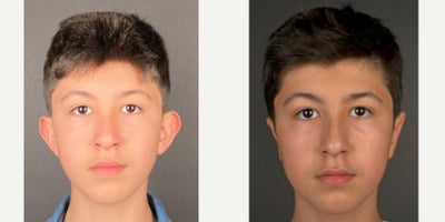 Ear Surgery before and after photo