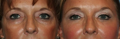 Facial Fat Transfer before and after photo