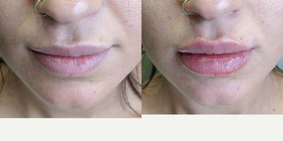 Lip Fillers before and after photo